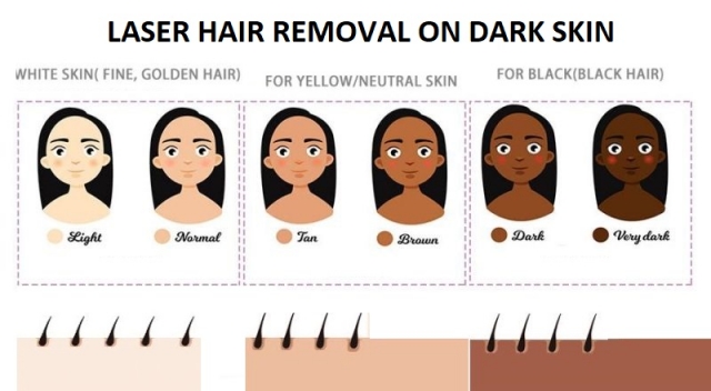 Laser Hair Removal For People With Dark Skin
